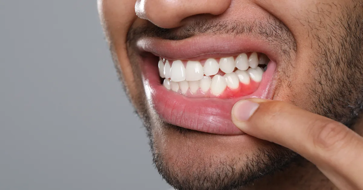 Dokter Gigi Spesialis Periodonsia di Banda Aceh — Perawatan Gusi, Scaling Lanjut & Bedah Periodontal